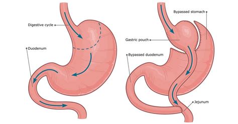 Bariatric patient blooming after gastric bypass surgery | Bailey Bariatrics