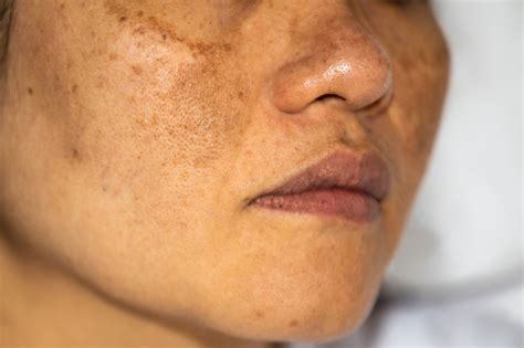 Skin Pigmentation Treatment in Ilford | Shumaila's