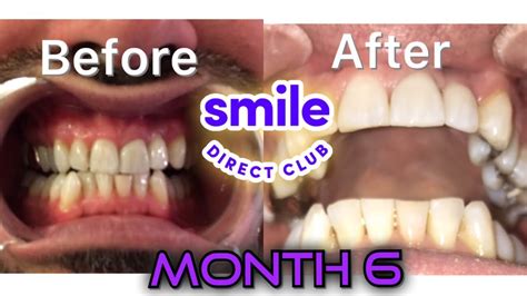 SmileDirectClub final set of aligners 🤩 (promo code) - YouTube