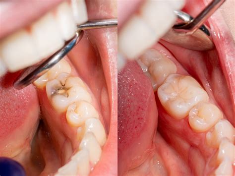 Everything You Need To Know About Composite Fillings