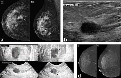 A 66-year-old female presented with right breast lump. (a) Digital... | Download Scientific Diagram