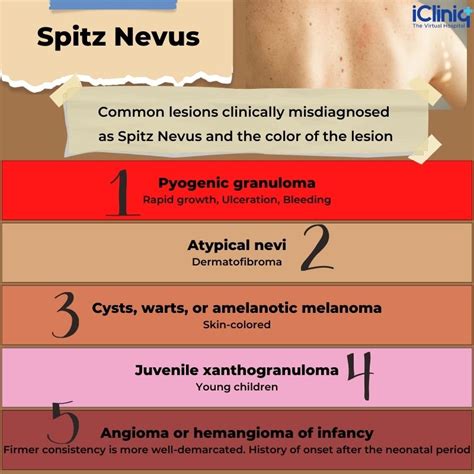 What Is Spitz Nevus?