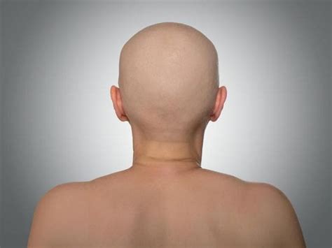 ABOUT ALOPECIA | Alopecia Philippines