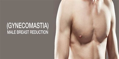 What is Gynecomastia - Causes, Symptoms, Grades, Treatment