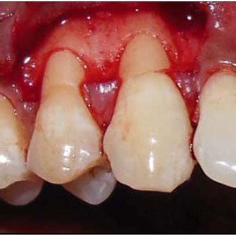 Harvested subepithelial Connective tissue graft. | Download Scientific ...