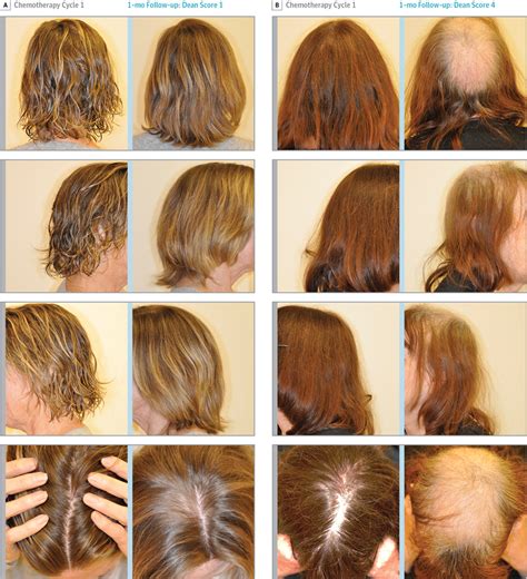 Association Between Use of a Scalp Cooling Device and Alopecia After Chemotherapy for Breast ...