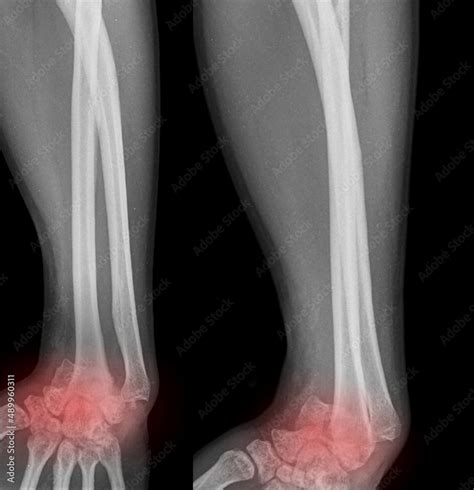 x ray of wrist dislocation Stock Photo | Adobe Stock