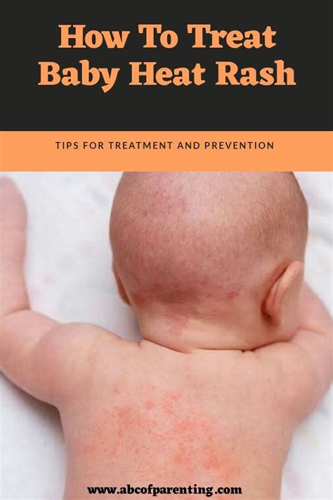 4 Best Ways To Treat Baby Heat Rash | Heat rash, Baby heat rash, Baby rash