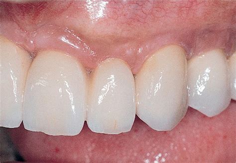 3: Implants for the maxillary edentulous patient | Pocket Dentistry