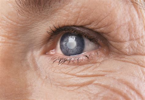 6 Early Signs of Glaucoma: What You Need To Know