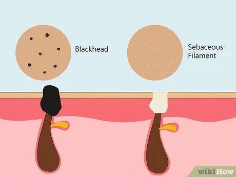 How to Get Rid of Sebaceous Filaments: 7 Effective Methods in 2024 | Sebaceous filaments ...