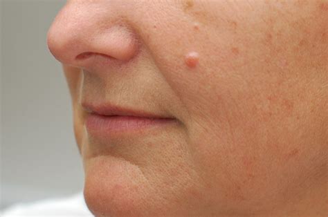 Moles, Warts, Skin Tags and Benign Growth Treatment Options