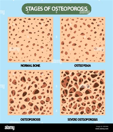 Bone Density and Osteoporosis Vector illustration Stock Vector Image & Art - Alamy