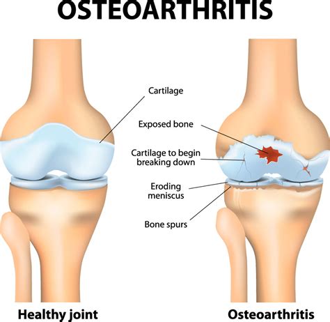 Knee Cartilage Injury | Knee Specialist | Austin, Round Rock, Cedar Park TX