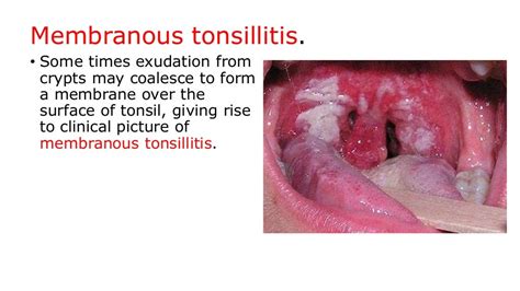 Tonsillitis, quinsy and adenoiditis