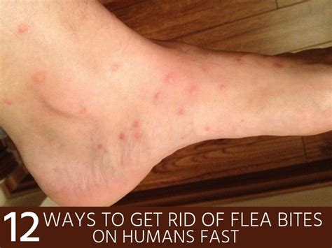 How To Treat Flea Allergy On Cats - GESTUUL