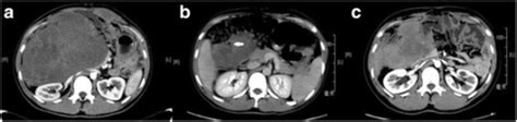 Desmoid tumor natural history, complications, and prognosis - wikidoc