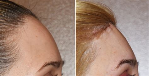 Plastic Surgery Case Study - Total Forehead Reshaping Surgery in a Female With Long and Narrow ...