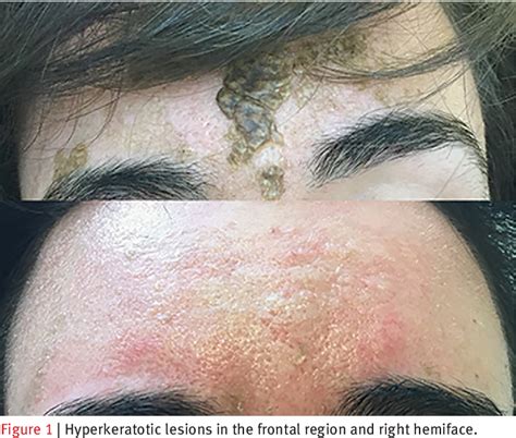 [PDF] Dermatitis neglecta: a challenging diagnosis in psychodermatology. | Semantic Scholar