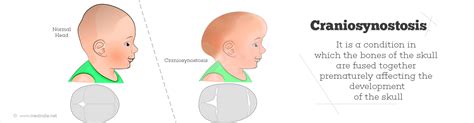 Craniosynostosis - Types, Causes, Symptoms, Diagnosis, Treatment ...