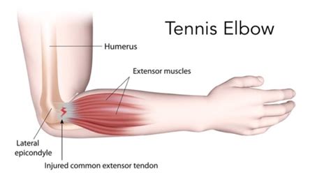 Tennis Elbow – what causes it, symptoms and treatment – Body Equilibrium Sports Massage and ...