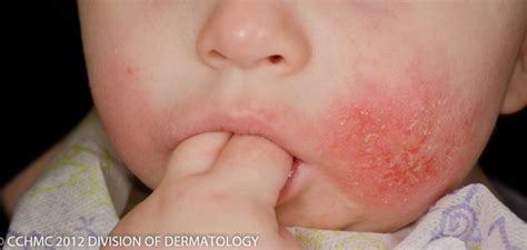 How to Treat Your Child's Eczema