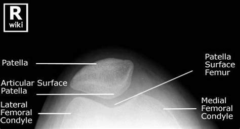 Radiographic Anatomy - Knee Skyline in 2020 | Anatomy, Radiology, Books