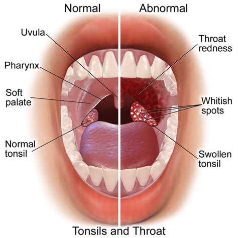 Difference Between Pharyngitis and Tonsillitis | Compare the Difference ...