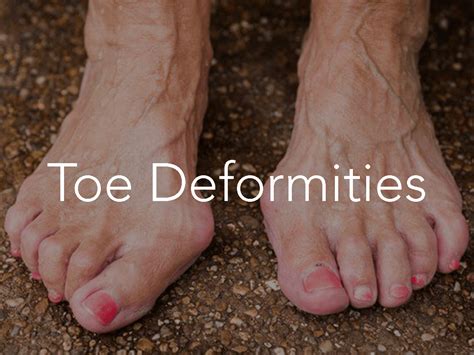 Frisco Toe Deformities | Frisco Foot & Ankle Specialists