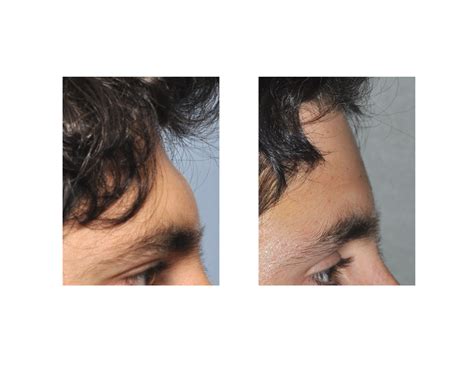 Plastic Surgery Case Study - Male Forehead Augmentation - Explore Plastic Surgery