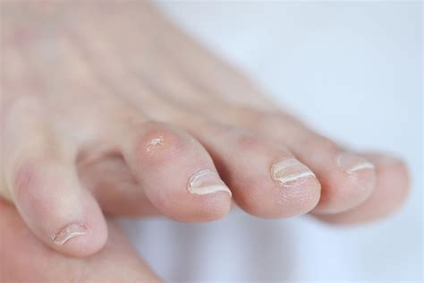 Corns and calluses - NHS