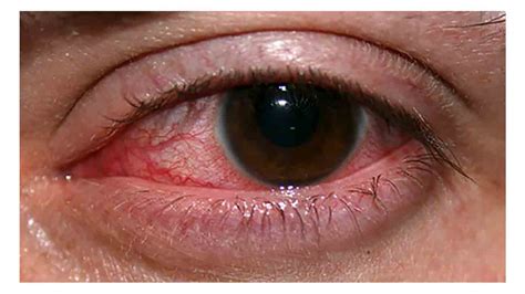 Makeup Eye Infection Symptoms | Makeupview.co