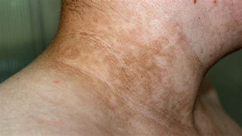 Acanthosis Nigricans Neck