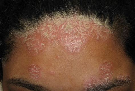 Skin Rash On Forehead Pictures Photos | Sexiz Pix