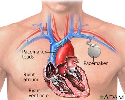 Pacemaker Implantation Symptoms, Doctors, Treatments, Advances & More | MediFind