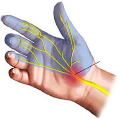 Sindrome Tunel Carpiano