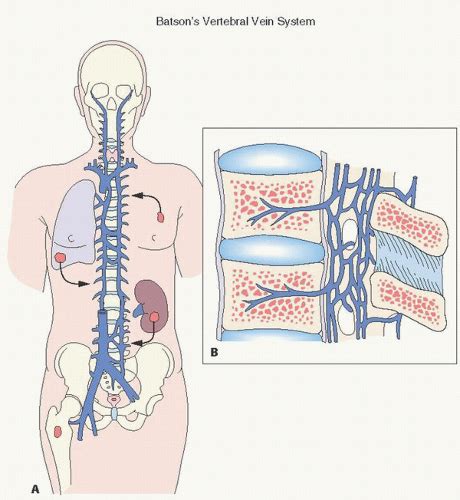 Metastatic Bone Disease | Basicmedical Key