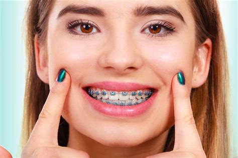 What are Spacers, Palate Expanders, and Permanent Retainers?