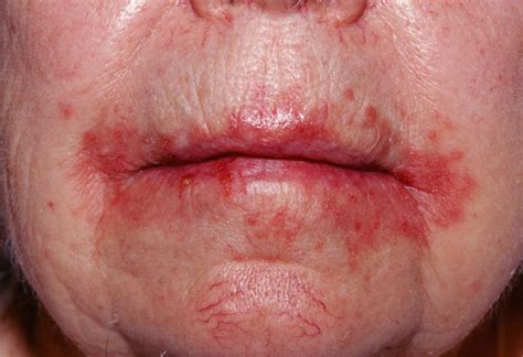 Cutaneous Candidiasis Skin Infection Facty Health - vrogue.co