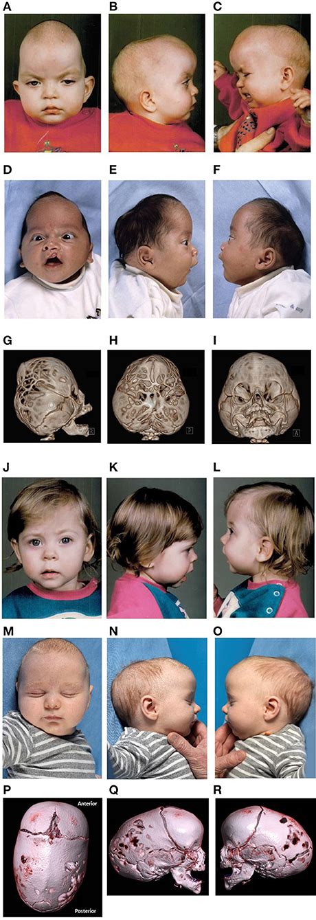 Frontiers | Case Report and Review of the Literature: Congenital ...