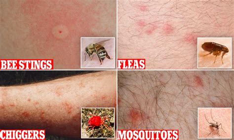 Mosquito Bites Vs Flea Bites