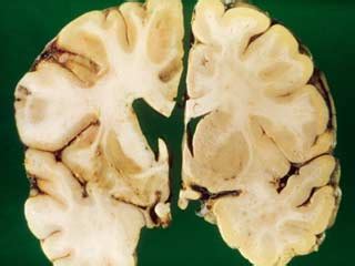 What are the common causes of chorea | Other Diseases