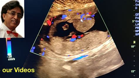 Succenturiate Lobe Placenta Ultrasound