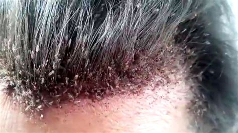 This video of a man's disgusting head lice infestation will make your skin crawl - Irish Mirror ...
