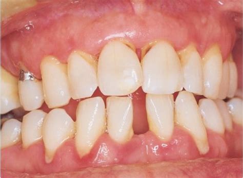 subgingival calculus Archives - Dentistry Today