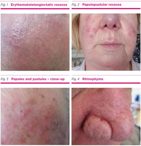 Acne Rosacea Vs Lupus Rash - Lupus Misdiagnosis Diseases That Can Mimic ...