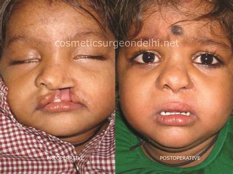 Craniofacial Surgery in Delhi | ID: 9835656012