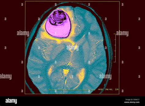 Zyste im gehirn -Fotos und -Bildmaterial in hoher Auflösung – Alamy