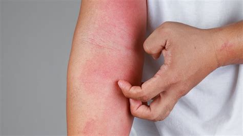 Skin Allergies: Symptoms And Treatments