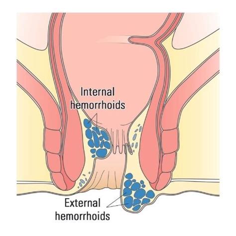 What Do Hemorrhoids Feel Like? Common Hemorrhoids Symptoms | lupon.gov.ph